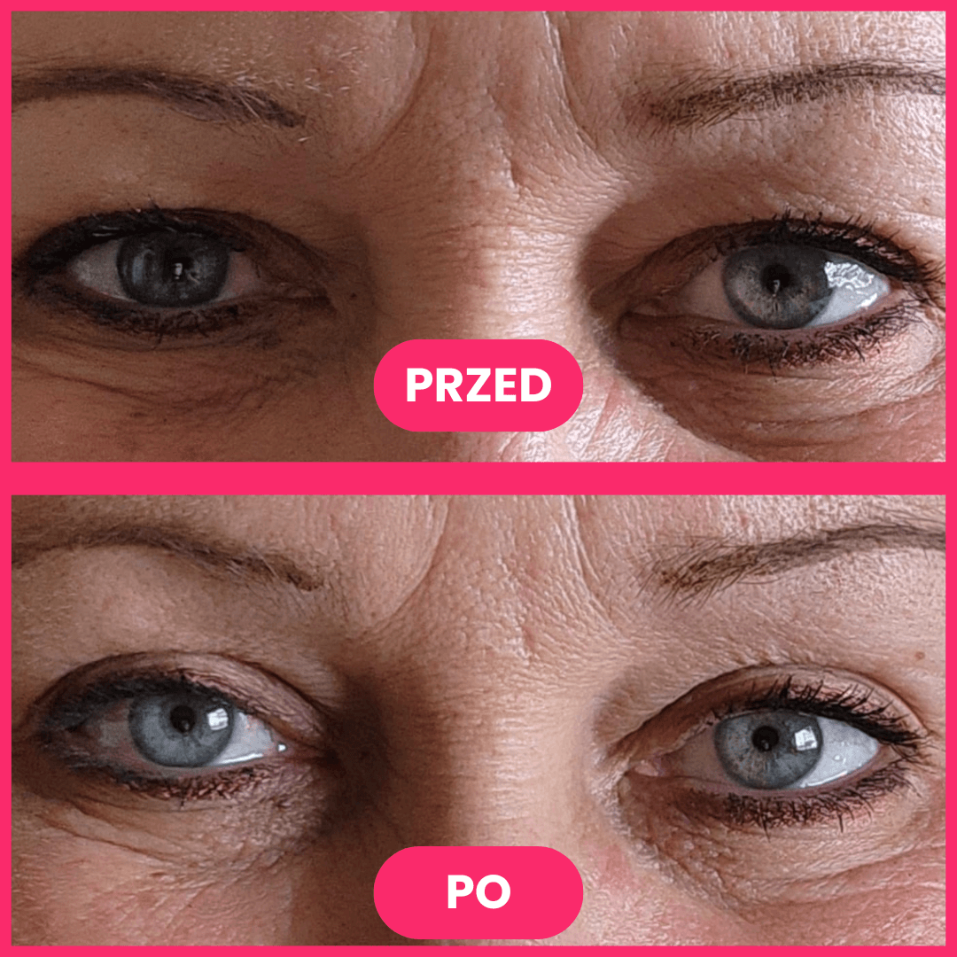 Eyefall - unieś powieki w 60 sekund bez drogich operacji (240 sztuk)